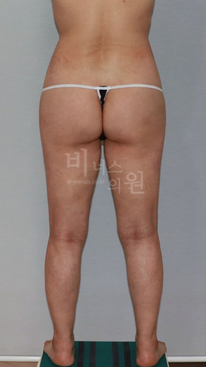 엉덩이 지방흡입(이중주름 볼륨이식 병행) 수술 후 1주 후면 사진