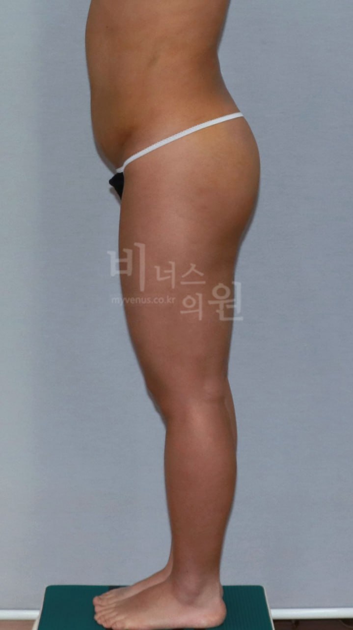엉덩이축소 지방흡입 전후사진 케이스1 측면 수술후 비너스의원