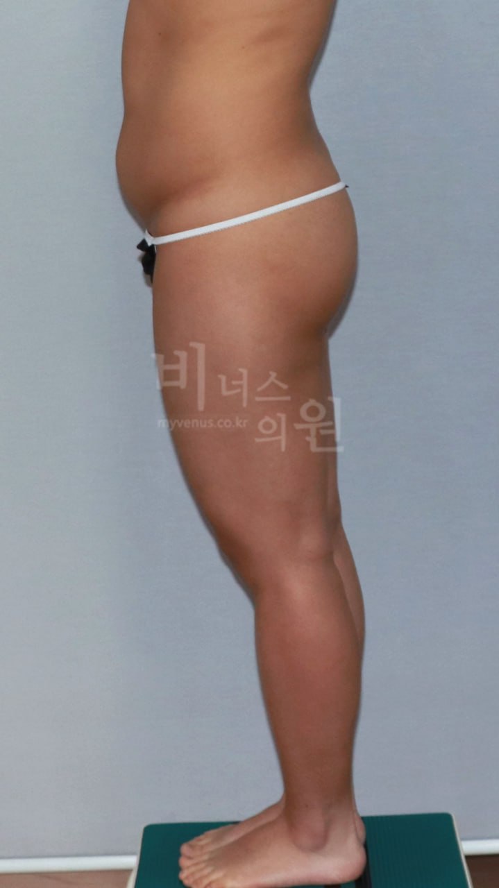 엉덩이축소 지방흡입 전후사진 케이스1 측면 수술전 비너스의원