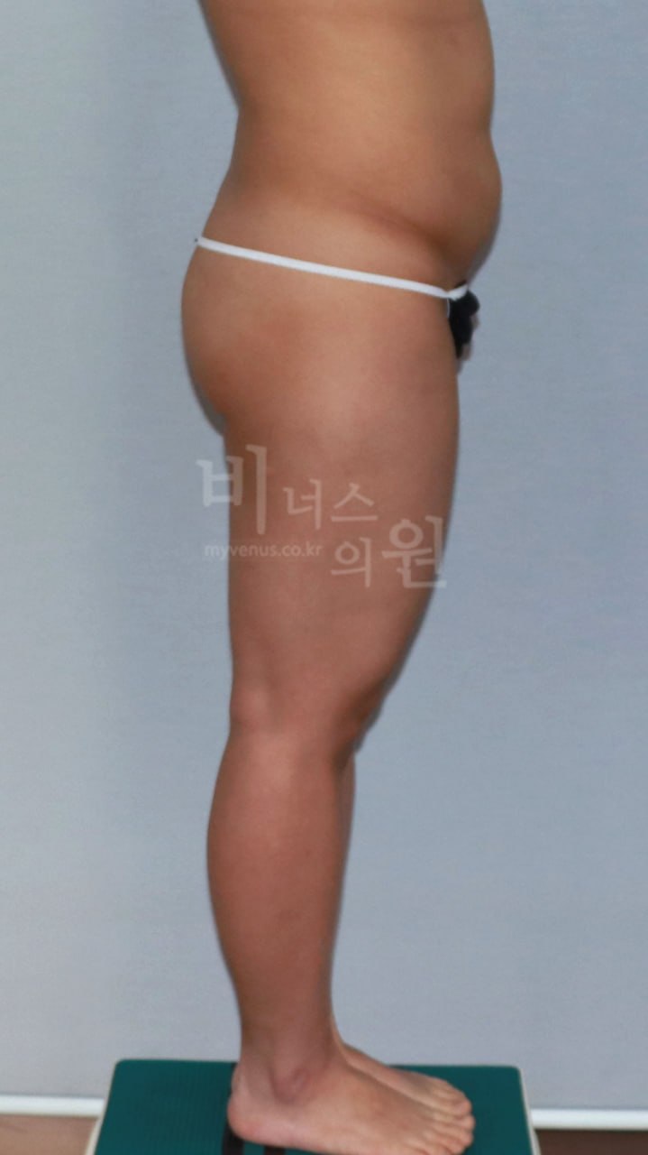 엉덩이축소 지방흡입 전후사진 케이스2 측면 수술전 비너스의원