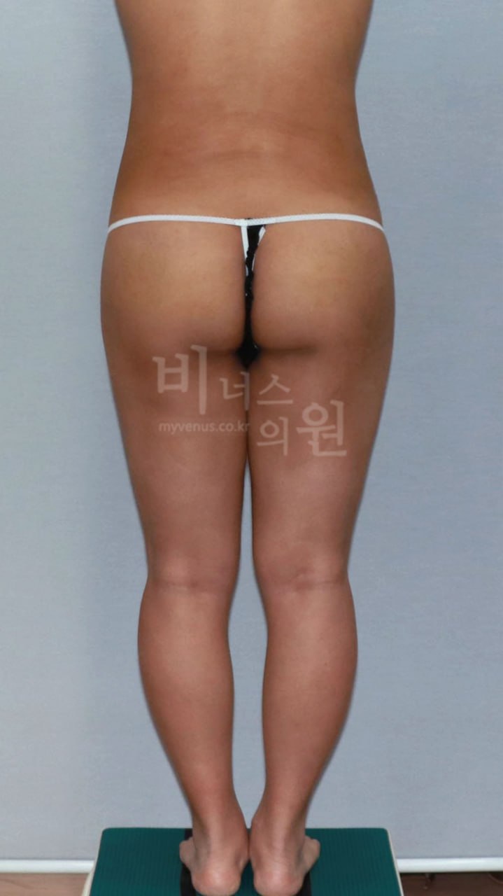 엉덩이축소 지방흡입 전후사진 케이스1 후면 수술후 비너스의원