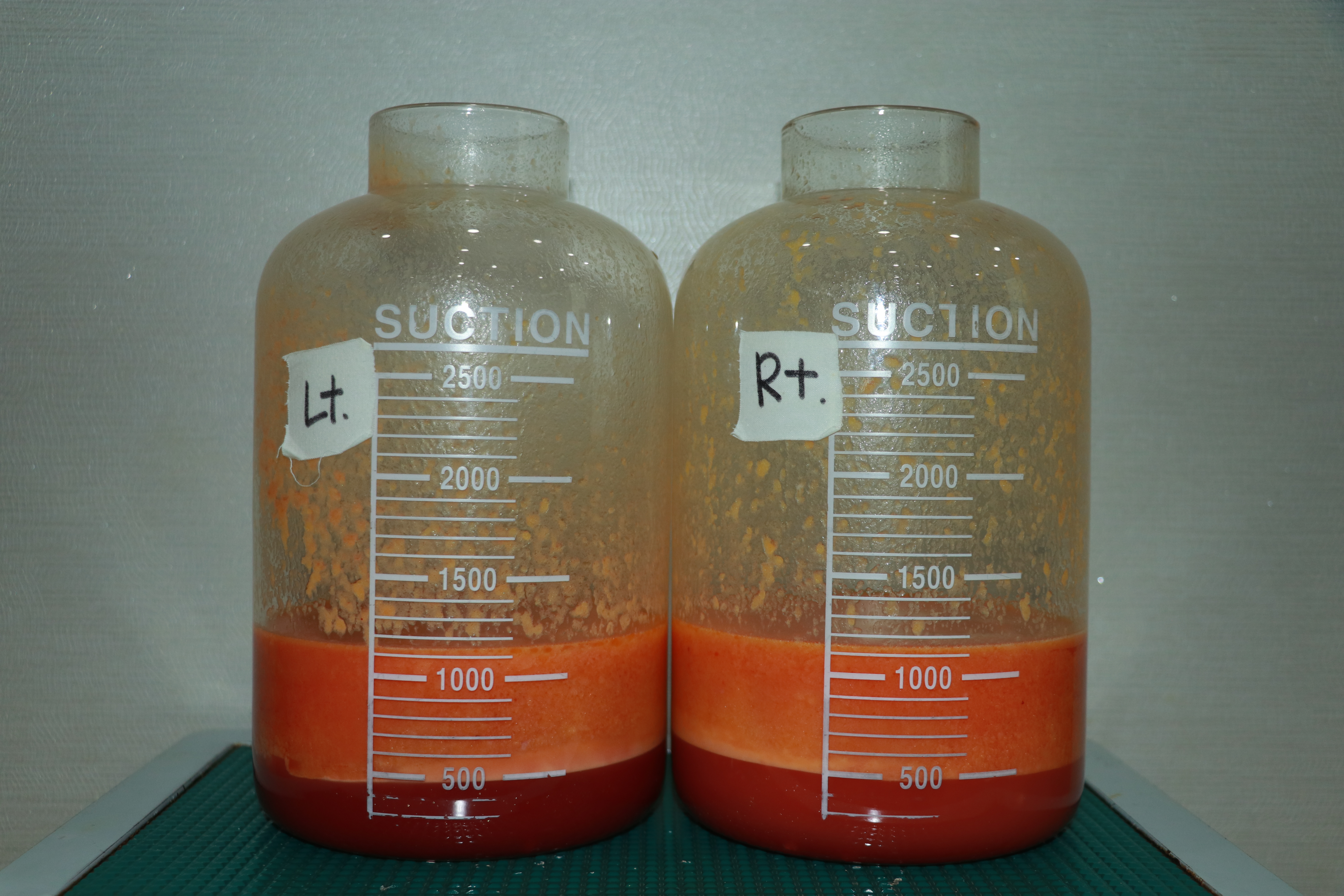 유방축소지방흡입 부작용 유방축소부작용 지방량 가슴축소방법 .JPG