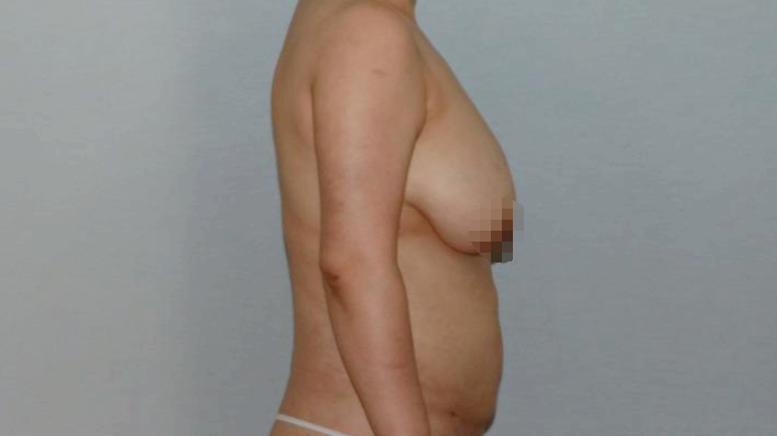 거대유방 큰가슴 유방하수 유두하수 지방흡입 유방축소 가슴축소 수술전.png