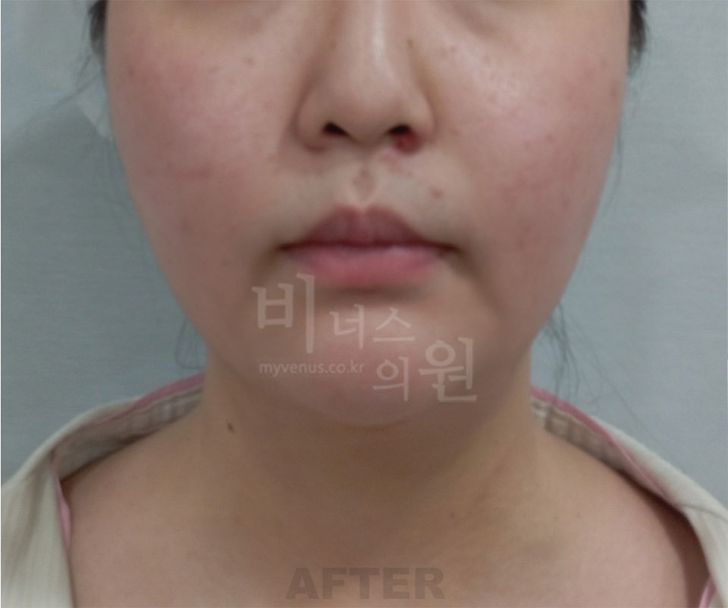 턱 이중턱 목 얼굴 지방흡입 수술 후 정면 비너스의원