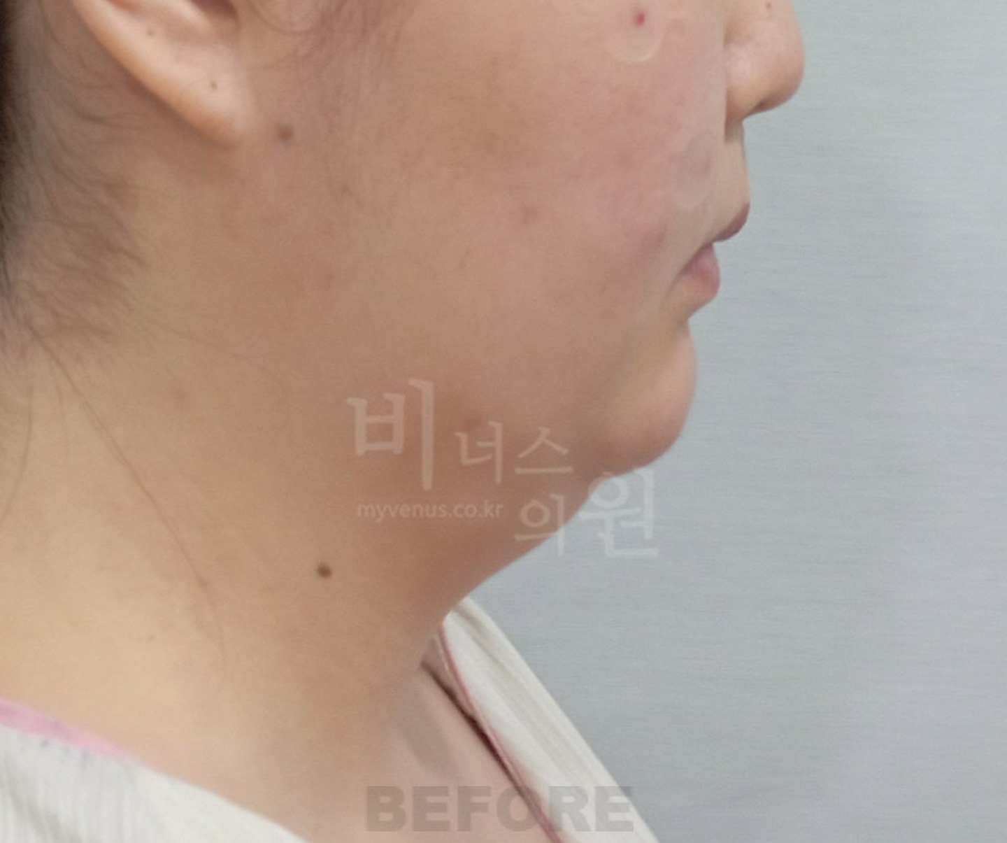 턱 이중턱 목 얼굴 지방흡입 수술 전 측면 ② 비너스의원