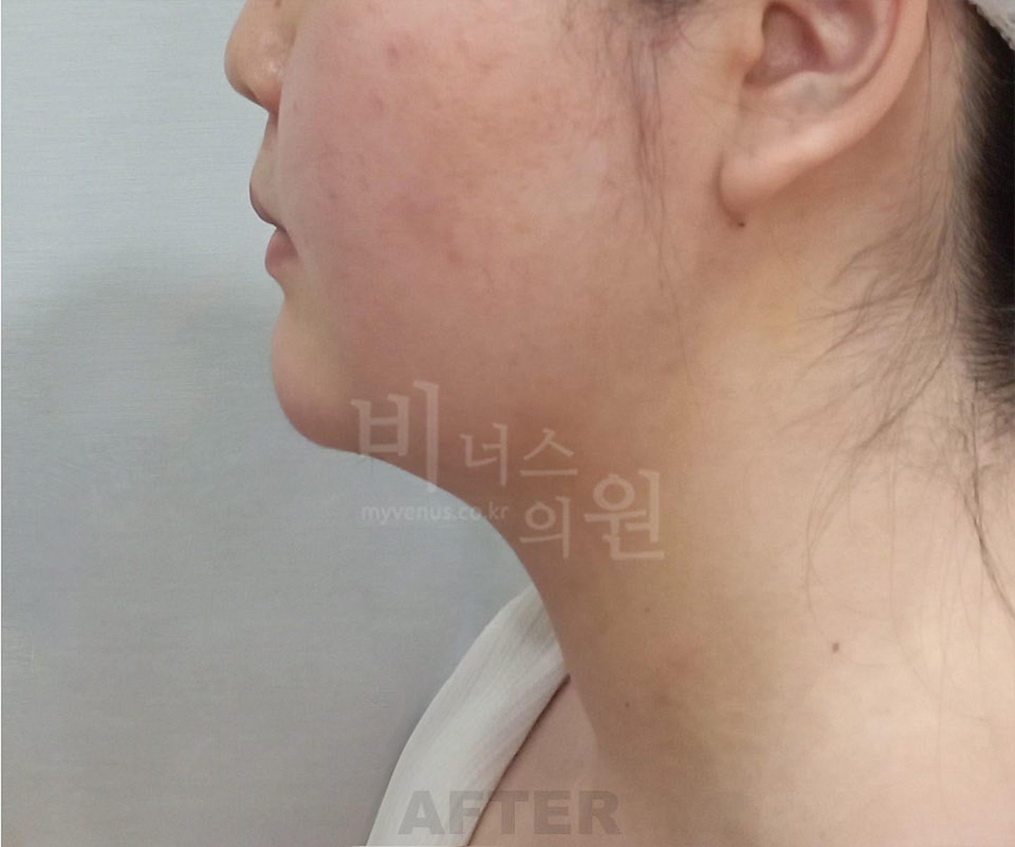 턱 이중턱 목 얼굴 지방흡입 수술 후 측면 ① 비너스의원