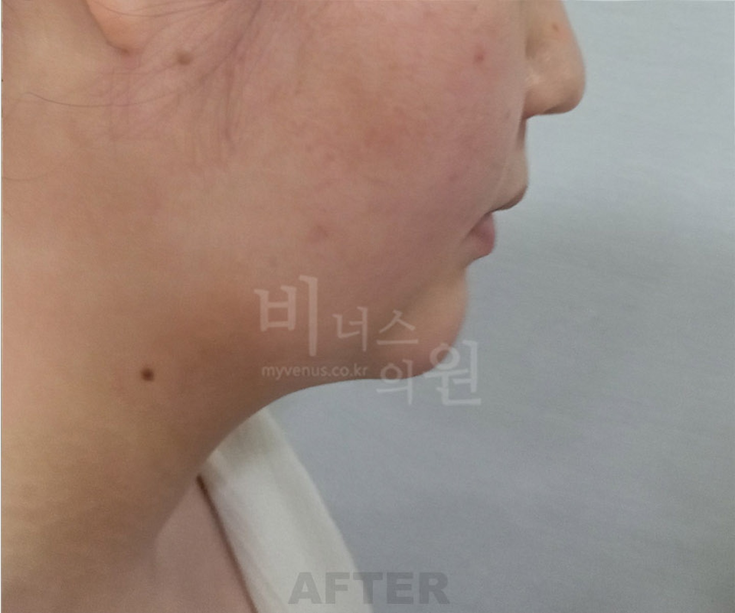 턱 이중턱 목 얼굴 지방흡입 수술 후 45도 측면 ② 비너스의원