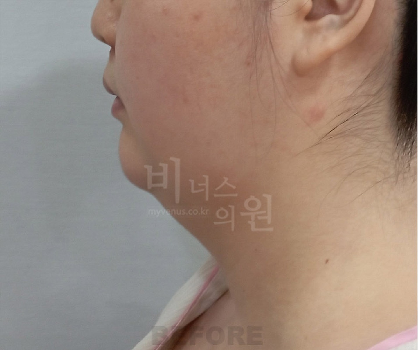 턱 이중턱 목 얼굴 지방흡입 수술 전 측면 ① 비너스의원