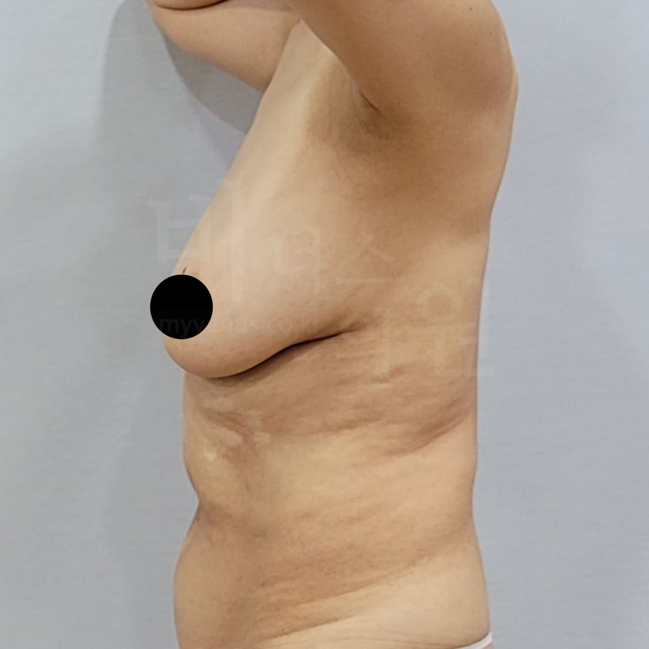 가슴축소 지방흡입 수술 전 우측 비너스의원