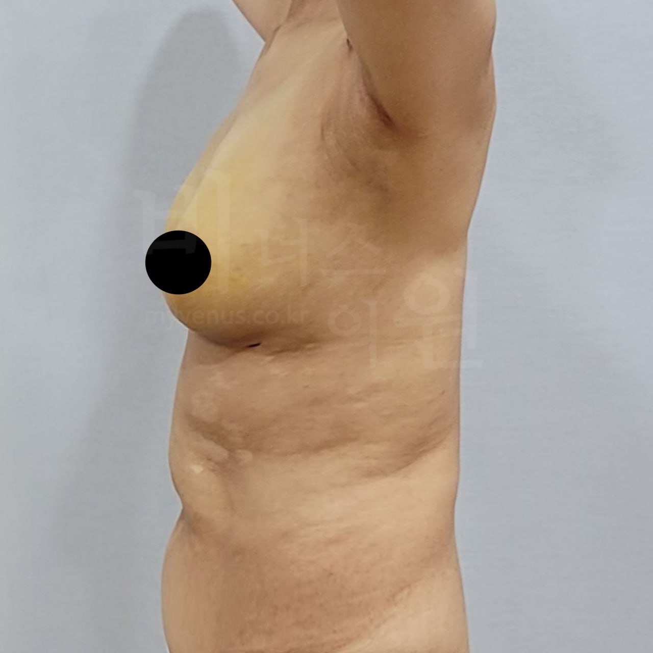 가슴축소 지방흡입 수술 후 우측 비너스의원