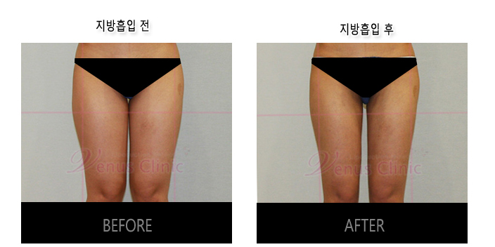 허벅지지방흡입.jpg