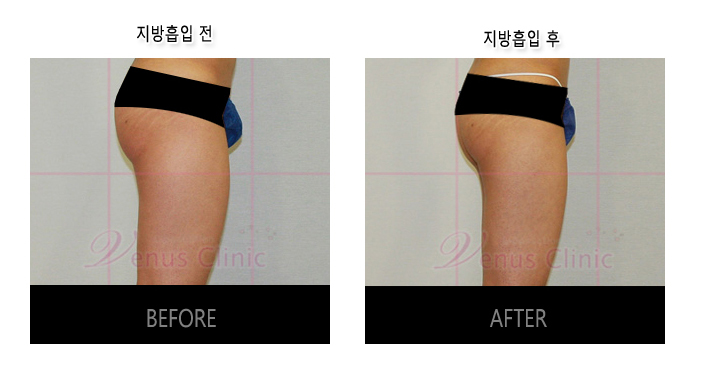 허벅지지방흡입2.jpg