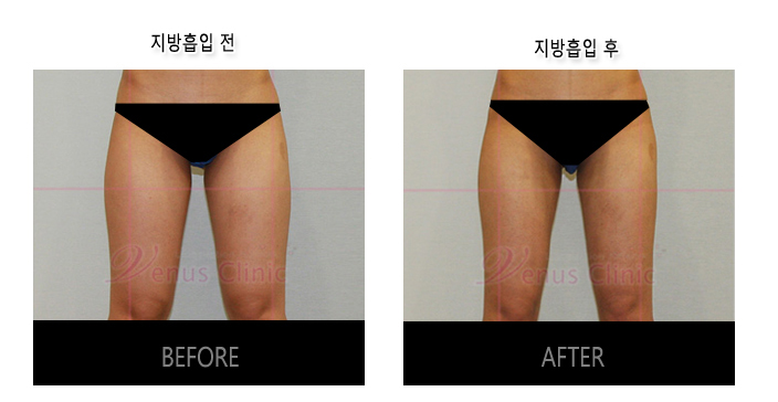 허벅지지방흡입1.jpg