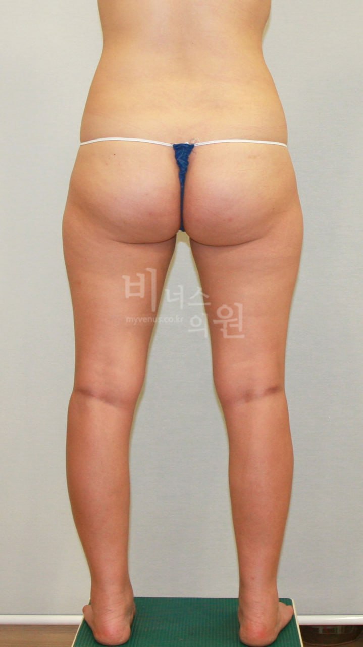허벅지 지방흡입 전 후면 비너스의원