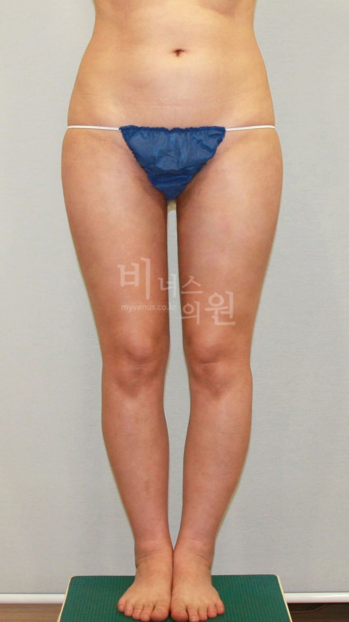 허벅지 지방흡입 후 정면 비너스의원