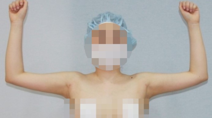 팔뚝 팔뚝살 팔 지방흡입 효과 경과 부작용 (2).jpg