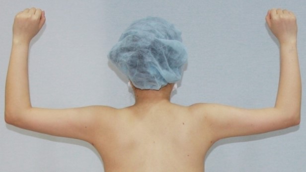 팔뚝 팔뚝살 팔 지방흡입 효과 경과 부작용 (3).jpg