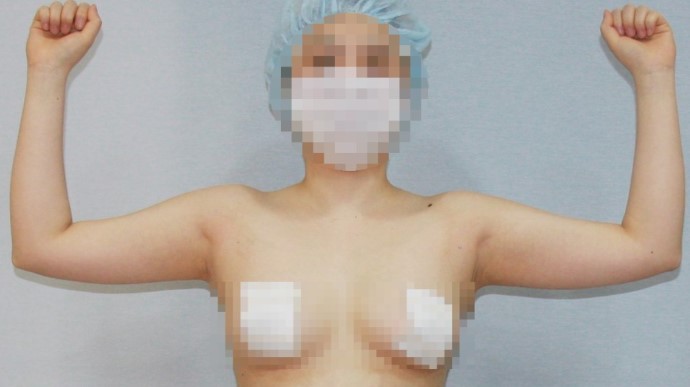 팔뚝살 팔뚝 팔 지방흡입 효과 부작용 (3).JPG