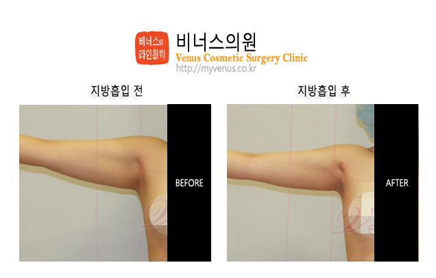 팔지방흡입1.jpg