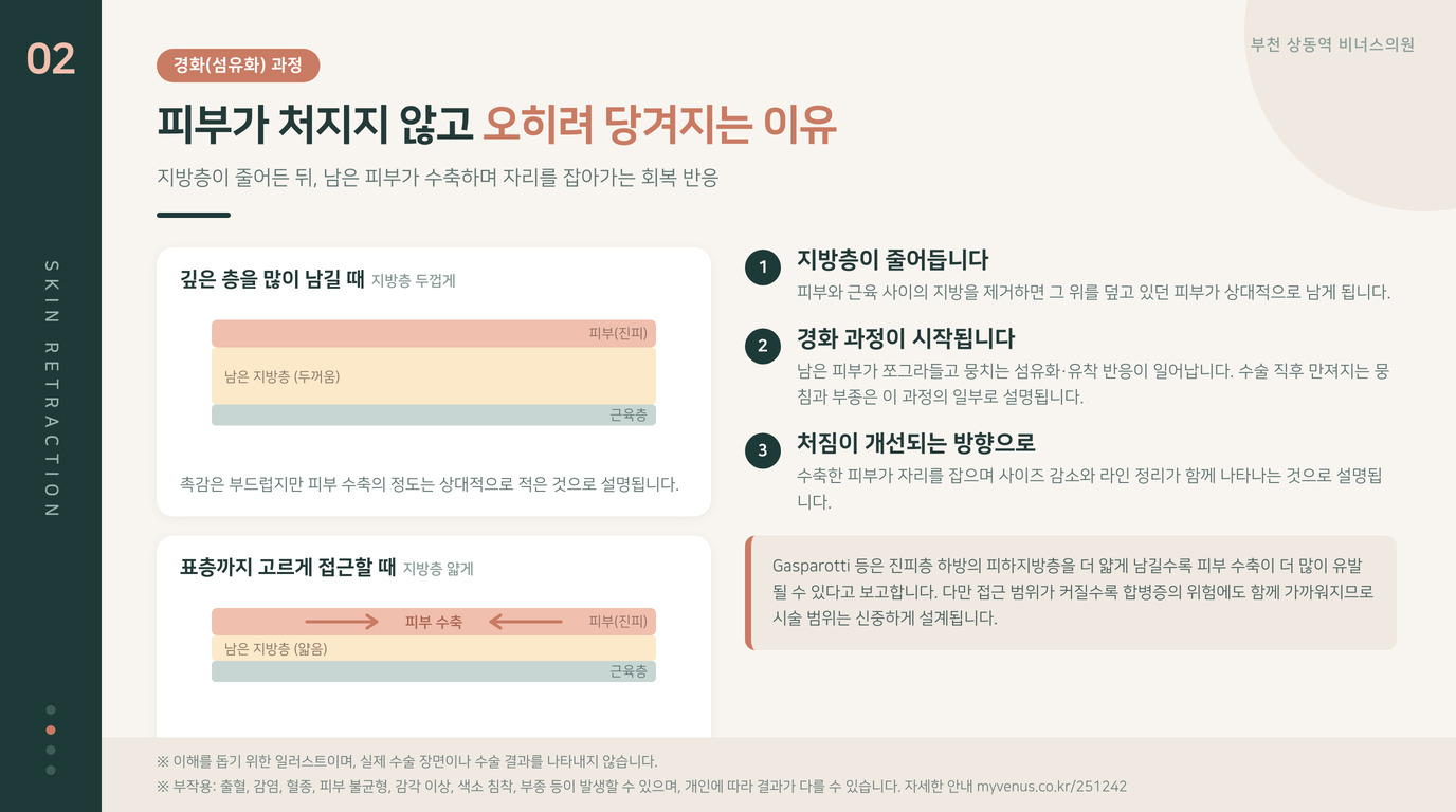 표층 지방흡입 후 피부가 수축되는 경화 과정 원리 일러스트 비너스의원