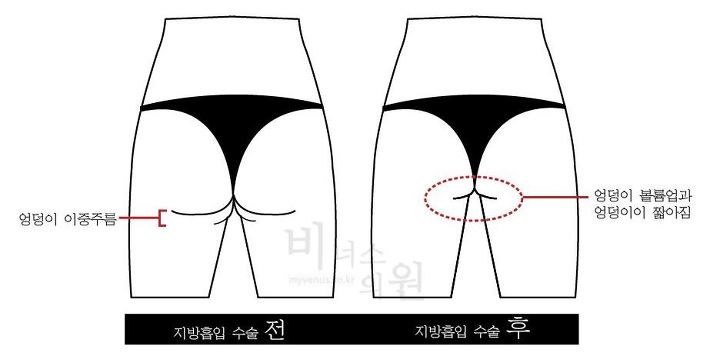엉덩이주름.jpg