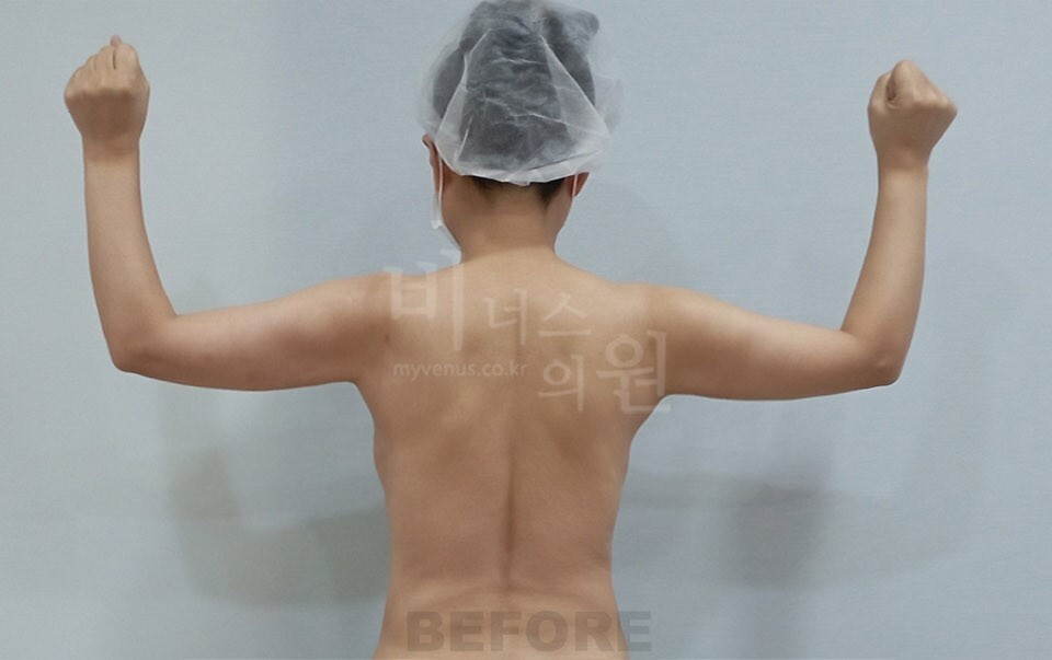 팔 지방흡입 수술 전 후면 팔 올린 자세 비너스의원