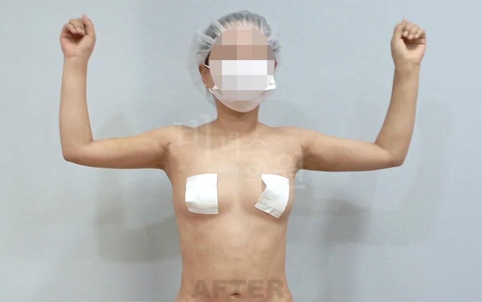 팔 지방흡입 수술 후 정면 팔 올린 자세 비너스의원