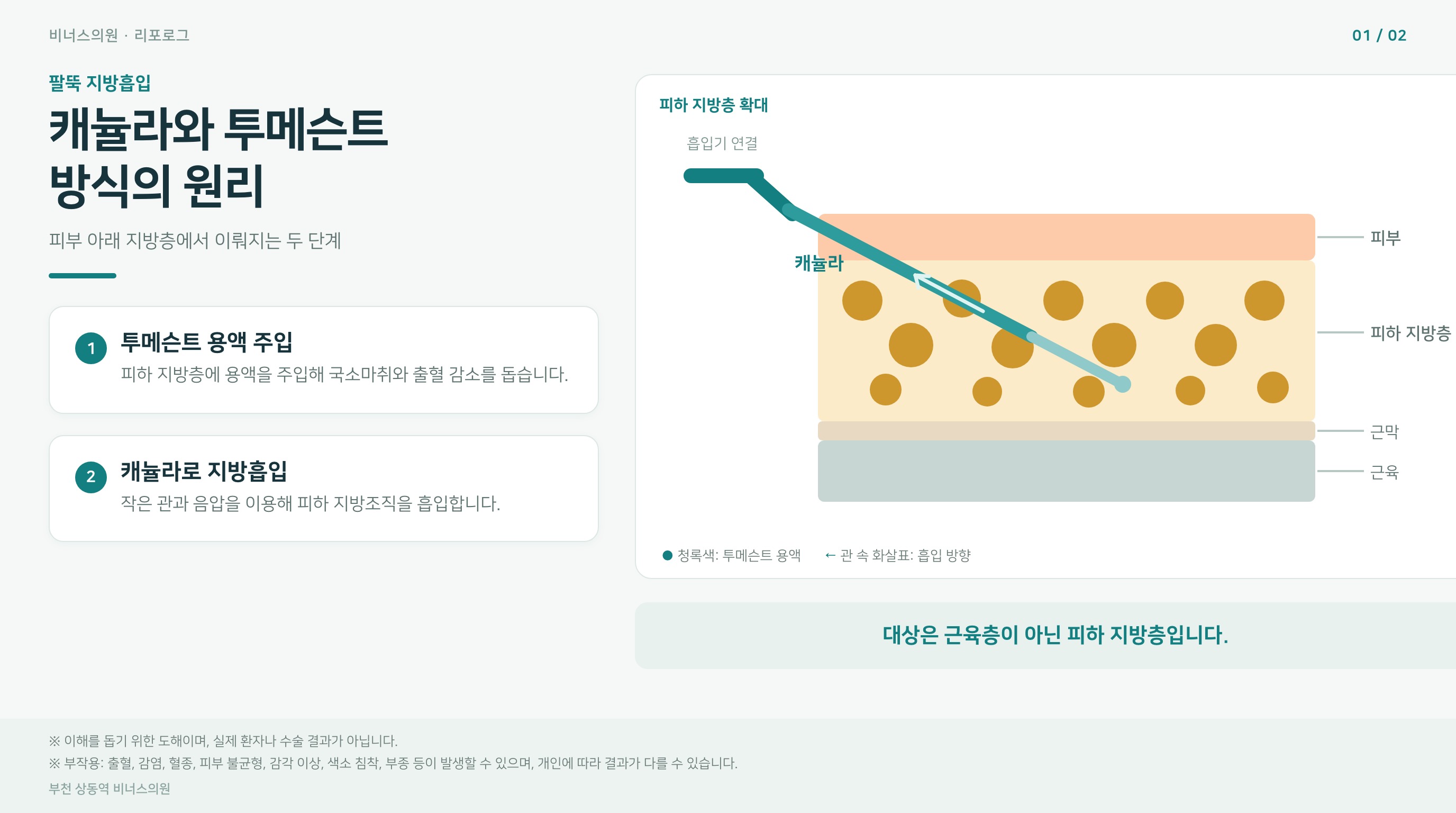 팔뚝 지방흡입 캐뉼라와 투메슨트 방식의 원리를 설명하는 도해