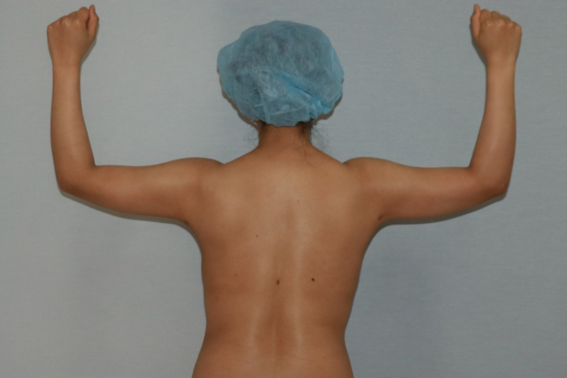 팔뚝지방흡입 팔뚝늘어짐 팔지방흡입 팔뚝지방흡입부작용 팔뚝지방흡입압박복 팔뚝지방흡입멍부기 팔뚝지방흡입경과 팔뚝지방흡입후기 팔뚝지방흡입전후사진 팔지방흡입수술후관리 팔지방흡입수술후경과 팔지방흡입흉터 팔지방흡입멍.jpg