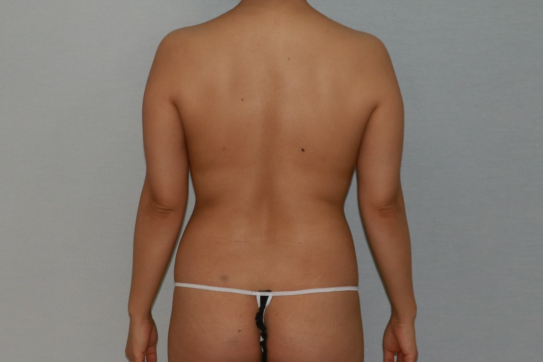 팔뚝지방제거 팔뚝지방흡입 팔뚝늘어짐 팔지방흡입 팔뚝지방흡입부작용 팔뚝지방흡입압박복 팔뚝지방흡입멍부기 팔뚝지방흡입경과 팔뚝지방흡입후기 팔뚝지방흡입전후사진 팔지방흡입수술후관리.jpg