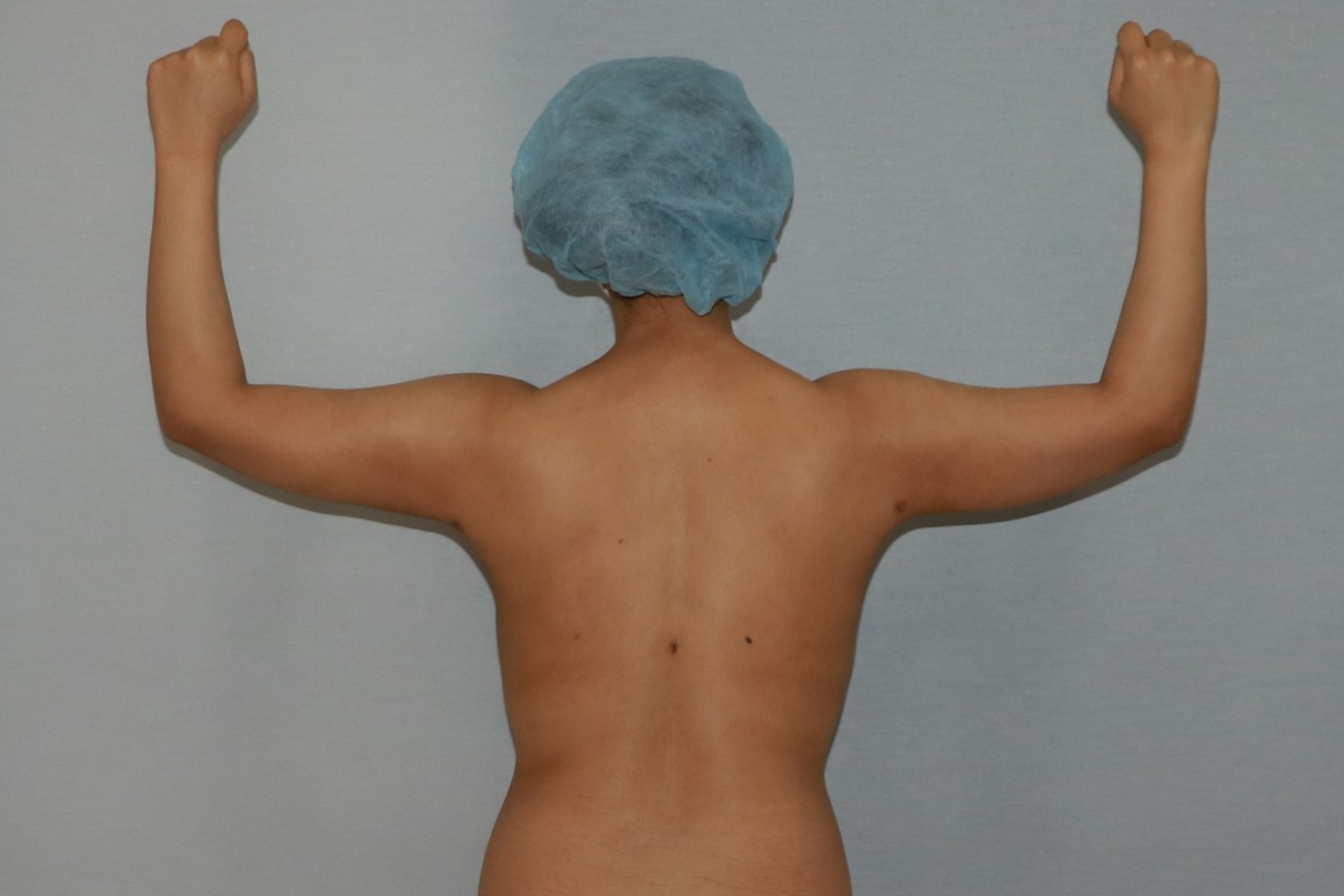 팔뚝지방흡입 팔뚝늘어짐 팔지방흡입 팔지방흡입부작용 팔뚝지방흡입부작용 팔뚝지방흡입압박복 팔뚝지방흡입멍부기 팔뚝지방흡입경과 팔뚝지방흡입후기 팔뚝지방흡입전후사진 팔지방흡입수술후관리 팔지방흡입수술후경과 팔지방흡입흉터.jpg