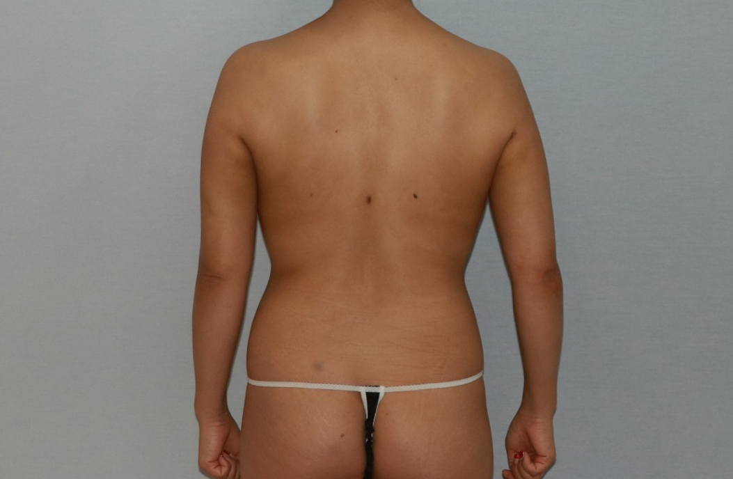 팔뚝지방제거 팔뚝지방흡입 팔뚝늘어짐 팔지방흡입 팔뚝지방흡입부작용 팔뚝지방흡입압박복 팔뚝지방흡입멍부기 팔뚝지방흡입경과 팔뚝지방흡입후기 팔뚝지방흡입전후사진 팔지방흡입수술후관리 팔.jpg