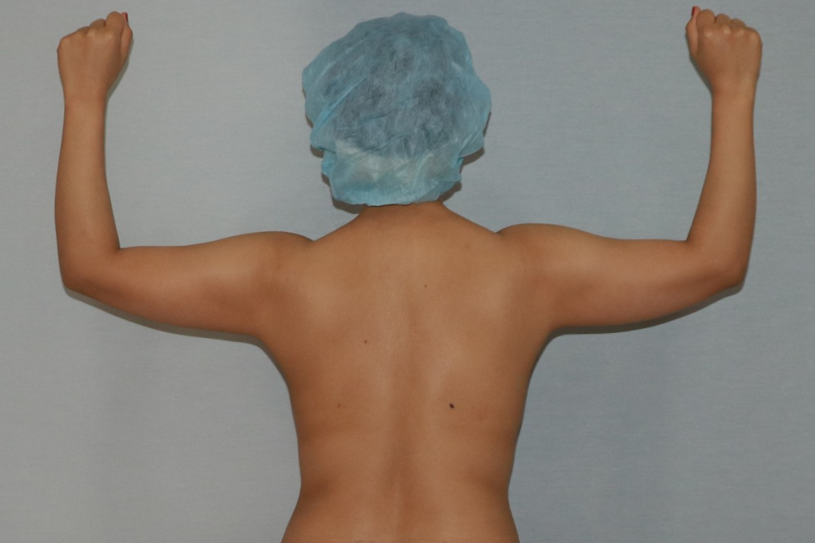 팔뚝지방흡입 팔뚝늘어짐 팔지방흡입 팔뚝지방흡입부작용 팔뚝지방흡입압박복 팔뚝지방흡입멍부기 팔뚝지방흡입경과 팔뚝지방흡입후기 팔뚝지방흡입전후사진 팔지방흡입수술후관리 팔지방흡입수술후경과 팔지방흡입흉터 팔지방흡입멍 팔지방흡입효과.jpg