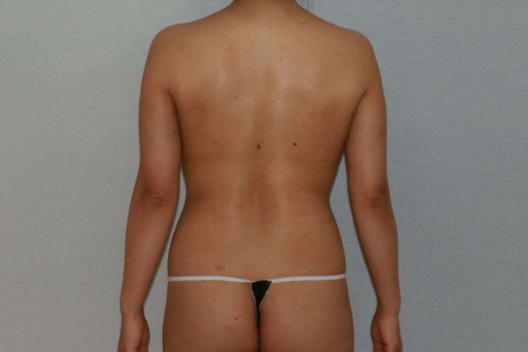 팔뚝지방제거 팔뚝지방흡입 팔뚝늘어짐 팔지방흡입 팔뚝지방흡입부작용 팔뚝지방흡입압박복 팔뚝지방흡입멍부기 팔뚝지방흡입경과 팔뚝지방흡입후기 팔뚝지방흡입전후사진 팔지방흡입수술후관리 팔 팔울퉁불퉁부작용재수술.jpg