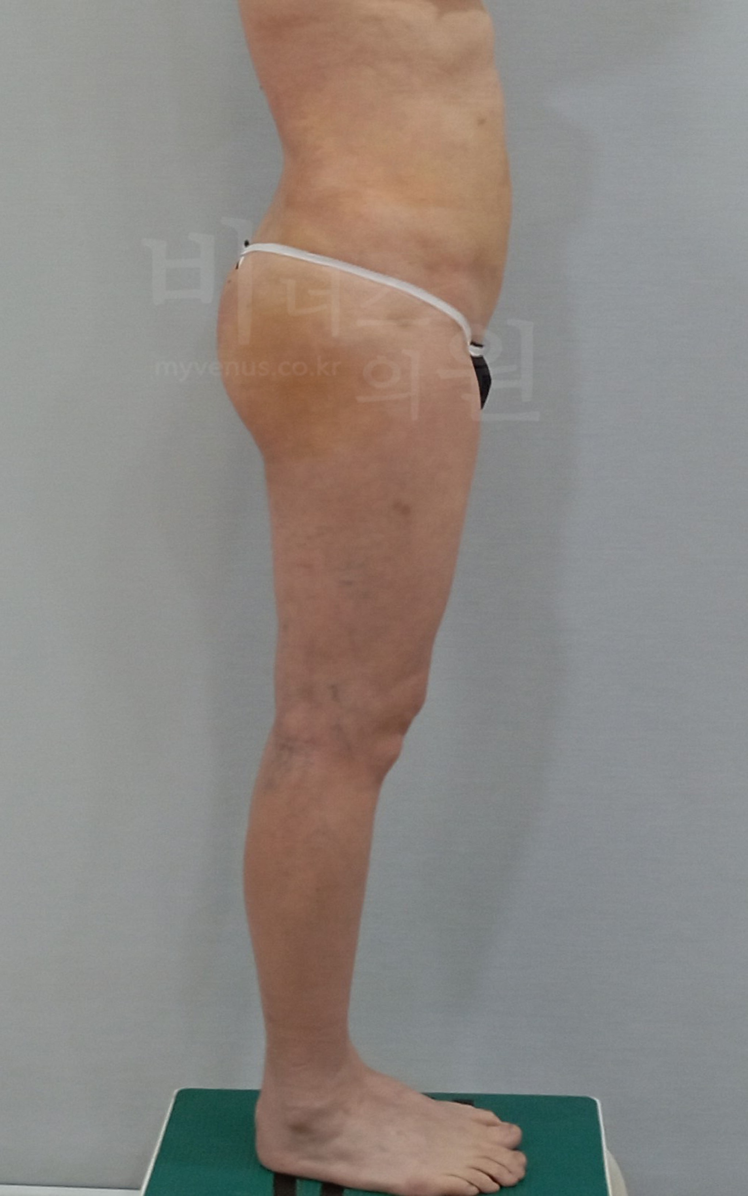 엉덩이축소 지방흡입 수술 후 우측면 비너스의원