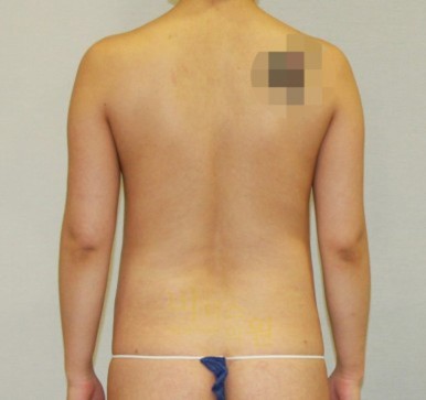 복부지방흡입17.jpg
