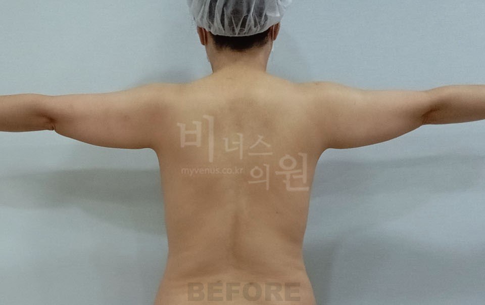 팔등 지방흡입 전 후면 비너스의원