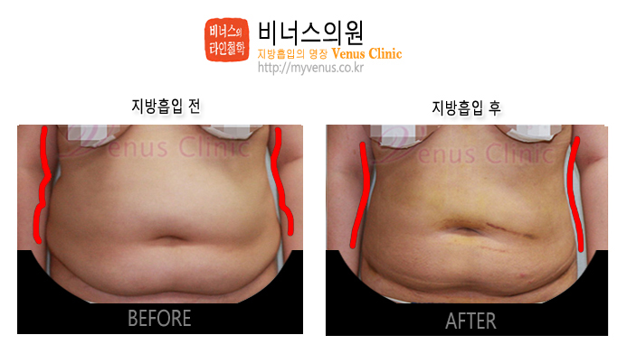인천지방흡입.jpg