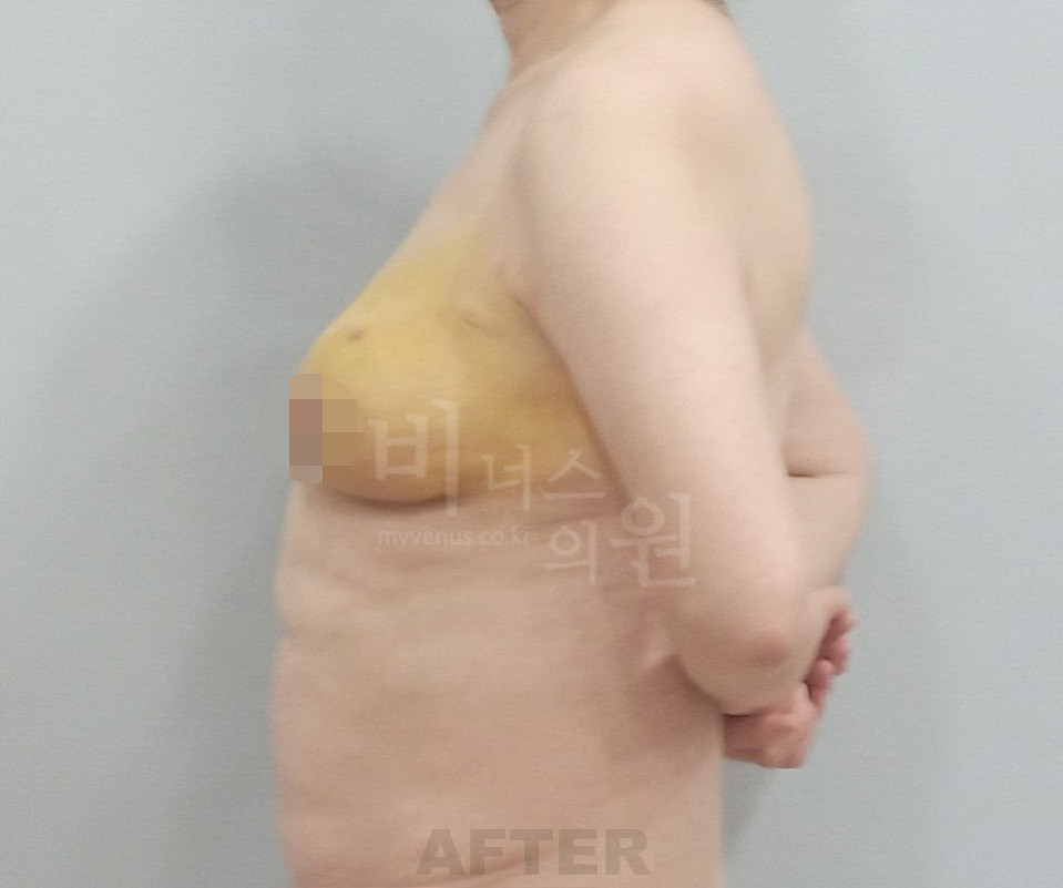 유방하수 표층 지방흡입 수술 후 측면 사례