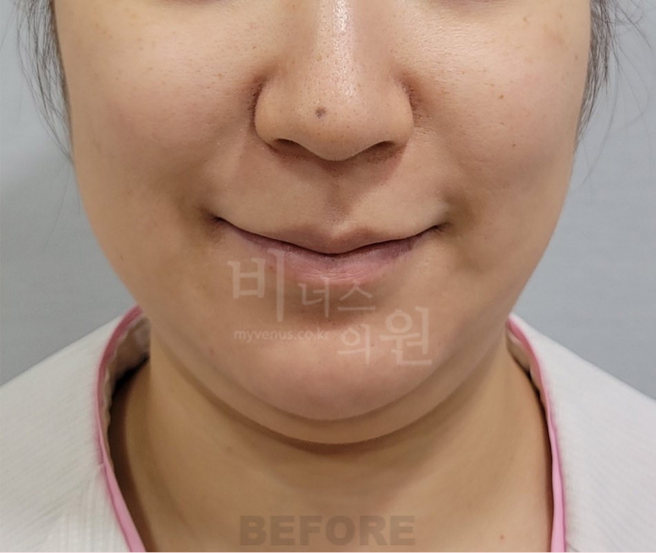 턱 지방흡입 수술 전 정면 비너스의원