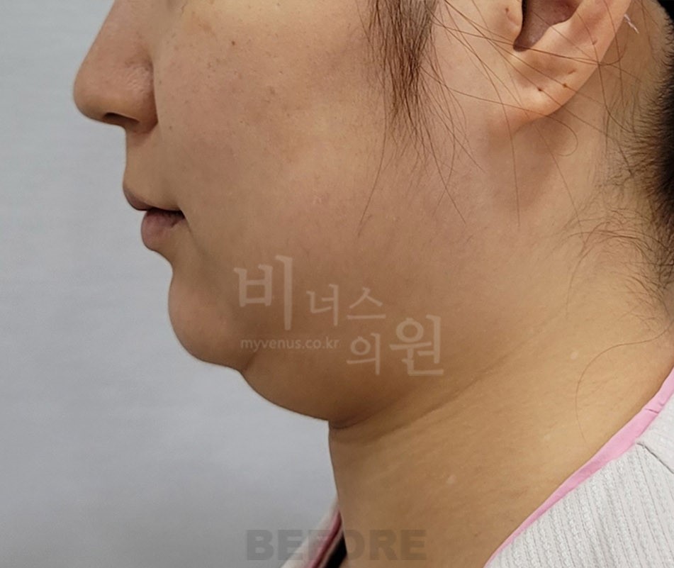 턱 지방흡입 수술 전 우측면 비너스의원
