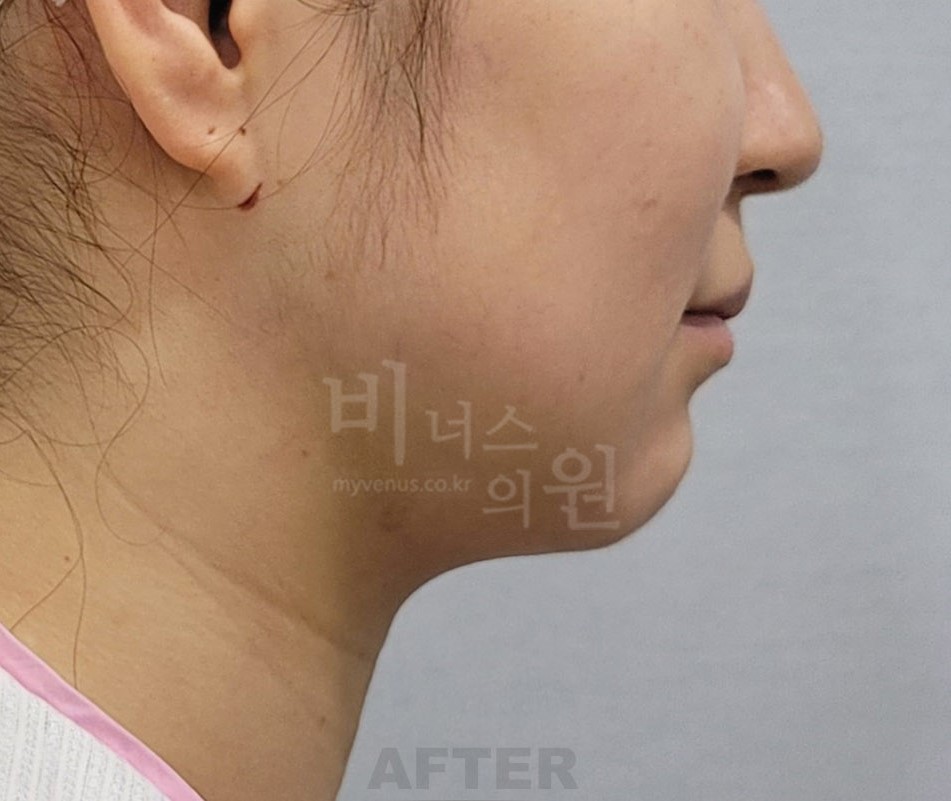 턱 지방흡입 수술 후 좌측면 비너스의원