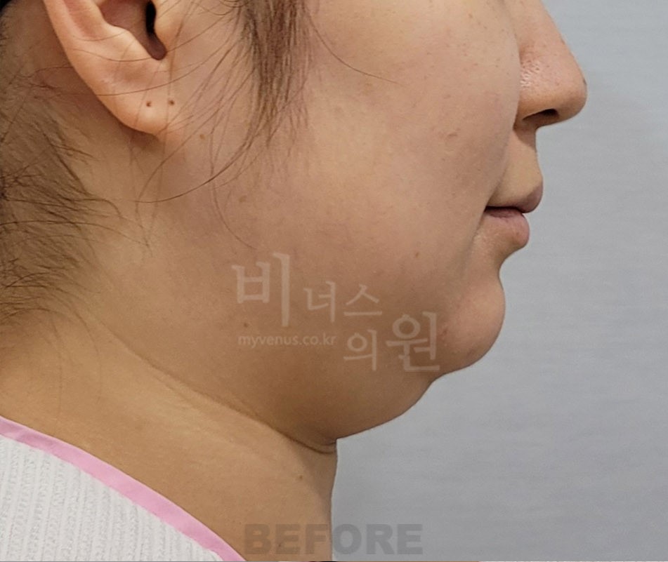 턱 지방흡입 수술 전 좌측면 비너스의원