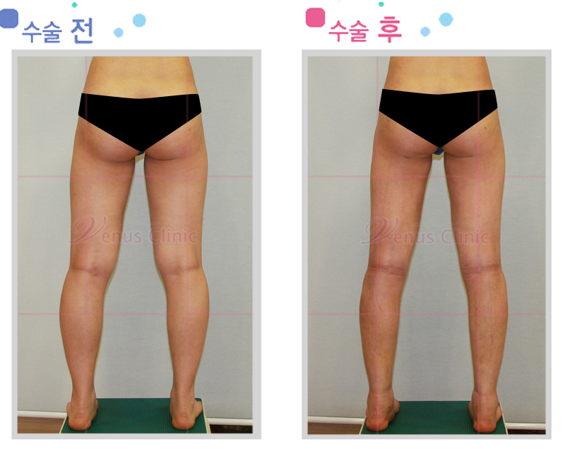 허벅지지방흡입2.jpg