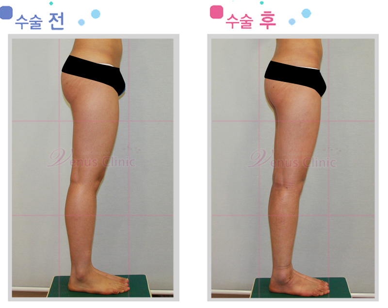 허벅지지방흡입1.jpg
