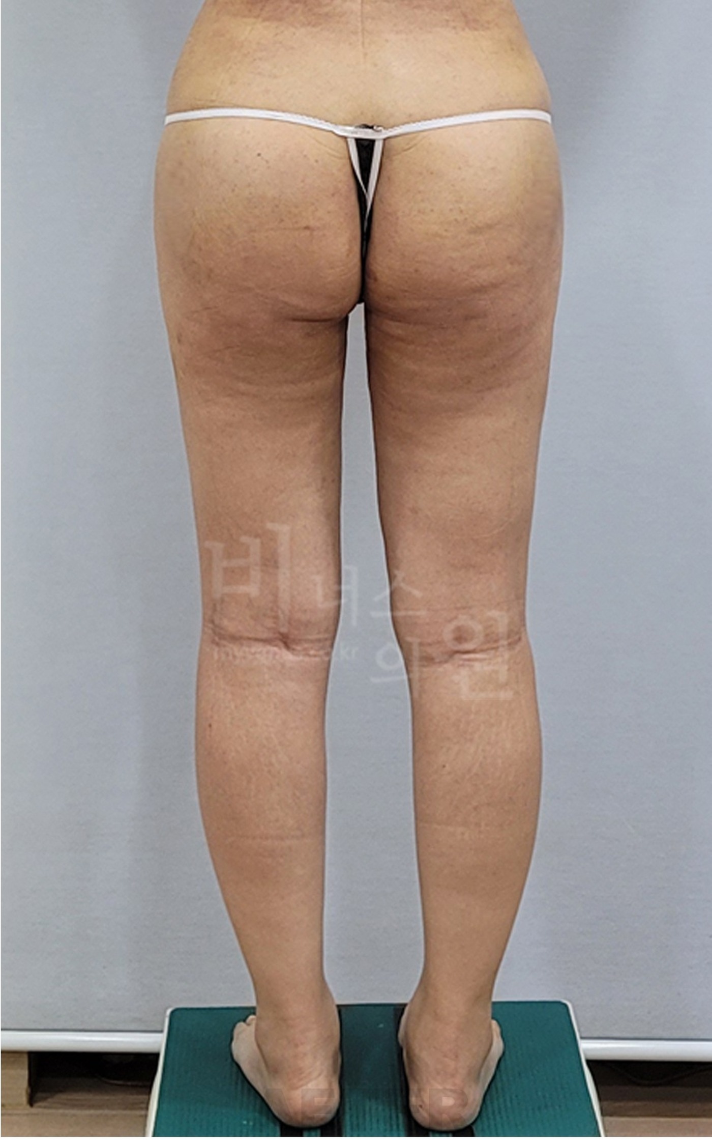 엉덩이축소 지방흡입 수술 후 후면 클로즈업 비너스의원