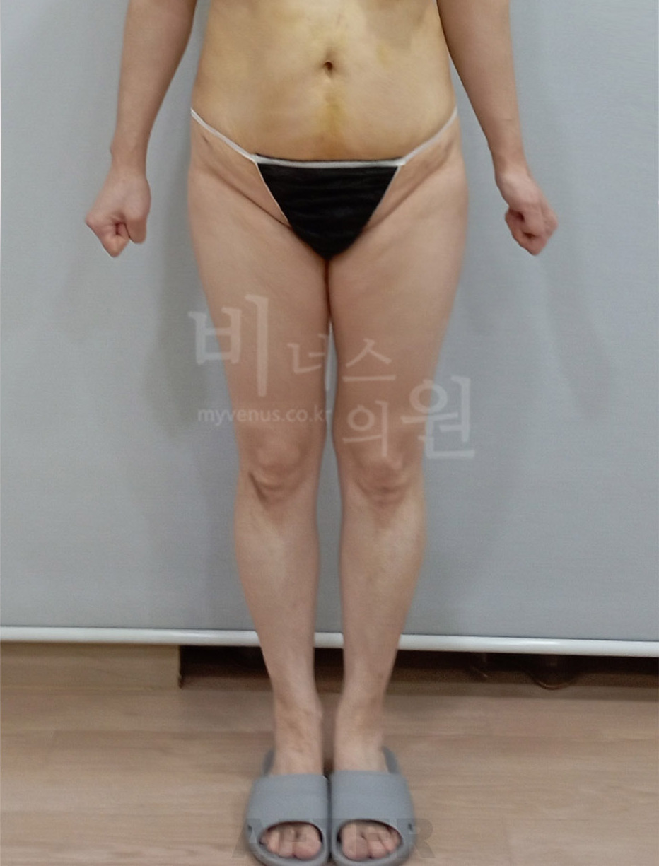 엉덩이축소 지방흡입 수술 후 정면 비너스의원