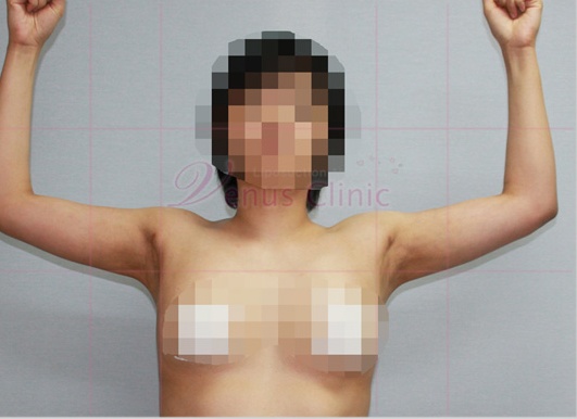 팔 지방흡입 수술 후 정면