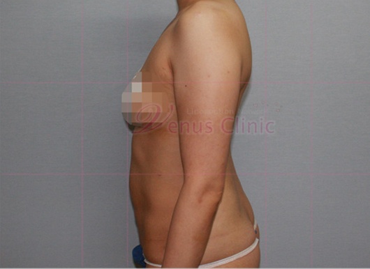 팔 지방흡입 수술 전 측면