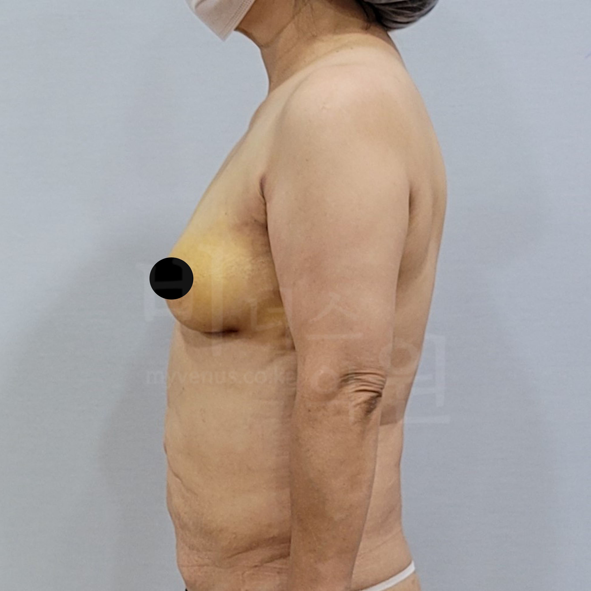 유방 가슴축소(거상) 지방흡입 수술 후 약 7개월 측면 사진